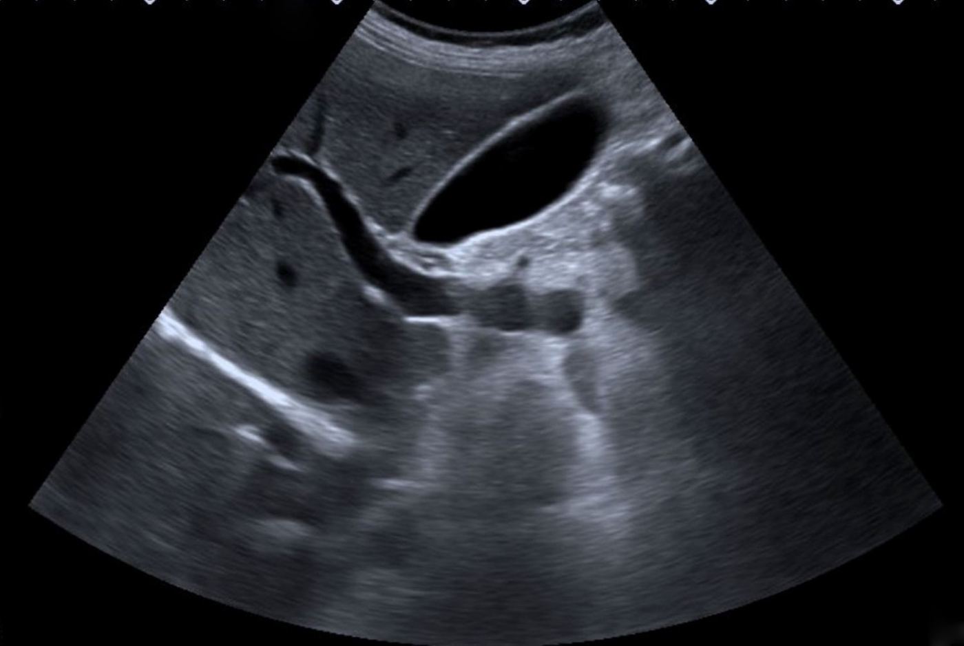 Abdominal ultrasound showing a gallbladder with clear walls and no stones